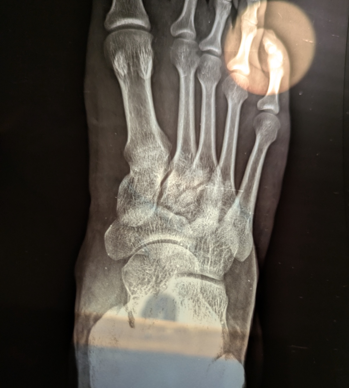 X-Ray report of my right foot